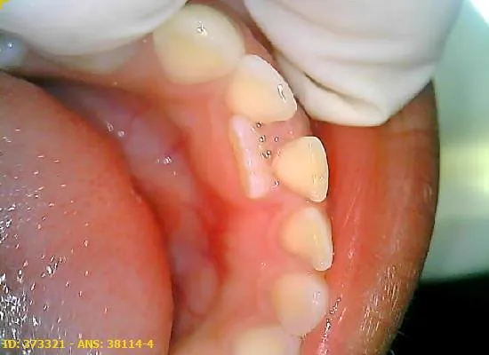 Dente eruptando fora de posição